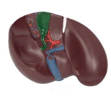 肝膽結(jié)石模型